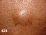 cyst epidermoid