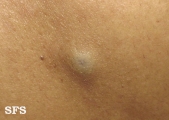 cyst epidermoid