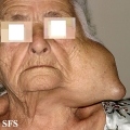 cyst epidermoid