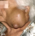 cyst epidermoid