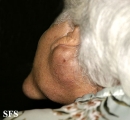 cyst epidermoid