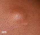 cyst epidermoid