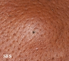 cyst epidermoid