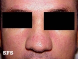 seborrhoeic dermatitis