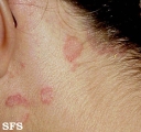 seborrhoeic dermatitis