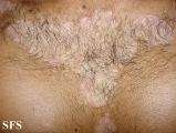 seborrhoeic dermatitis