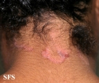 seborrhoeic dermatitis