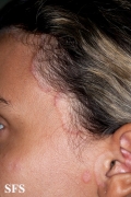seborrhoeic dermatitis