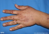 porphyria cutanea tarda