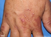porphyria cutanea tarda