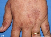 porphyria cutanea tarda