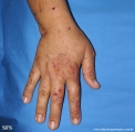 porphyria cutanea tarda