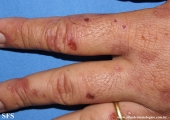 porphyria cutanea tarda