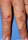 porphyria cutanea tarda