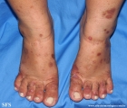 porphyria cutanea tarda