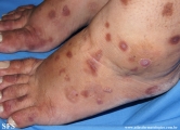 porphyria cutanea tarda