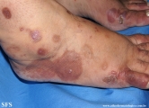 porphyria cutanea tarda