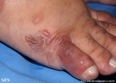 porphyria cutanea tarda