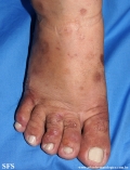 porphyria cutanea tarda