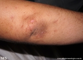 porphyria cutanea tarda