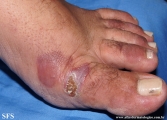 porphyria cutanea tarda
