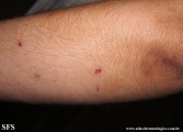 porphyria cutanea tarda