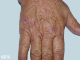 porphyria cutanea tarda