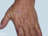 porphyria cutanea tarda