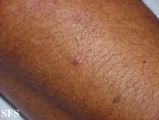 porphyria cutanea tarda