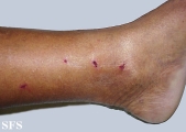 porphyria cutanea tarda