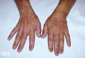porphyria cutanea tarda