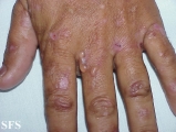 porphyria cutanea tarda
