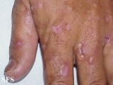 porphyria cutanea tarda