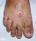 porphyria cutanea tarda