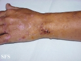 porphyria cutanea tarda