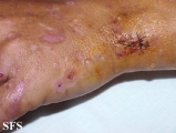 porphyria cutanea tarda
