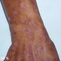 porphyria cutanea tarda