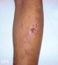 porphyria cutanea tarda