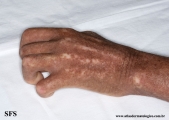 systemic_sclerosis