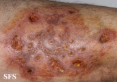 granuloma annulare-perforanting granuloma annulare