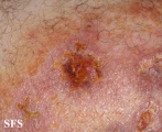granuloma annulare-perforanting granuloma annulare