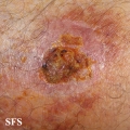 granuloma annulare-perforanting granuloma annulare