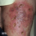 granuloma annulare-perforanting granuloma annulare