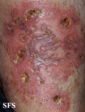 granuloma annulare-perforanting granuloma annulare