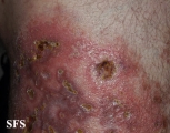 granuloma annulare-perforanting granuloma annulare