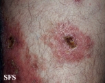 granuloma annulare-perforanting granuloma annulare