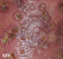 granuloma annulare-perforanting granuloma annulare