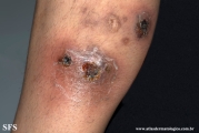 granuloma annulare-perforanting granuloma annulare