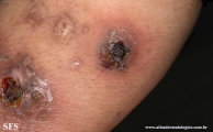 granuloma annulare-perforanting granuloma annulare