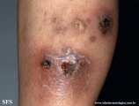 granuloma annulare-perforanting granuloma annulare